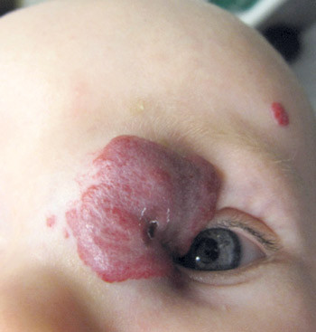 Figur 1  Hemangiomet f&oslash;r behandling