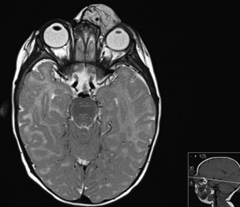 Figur 2  MR orbita f&oslash;r behandling &ndash; hemangiomet og avflating av bulbus oculi