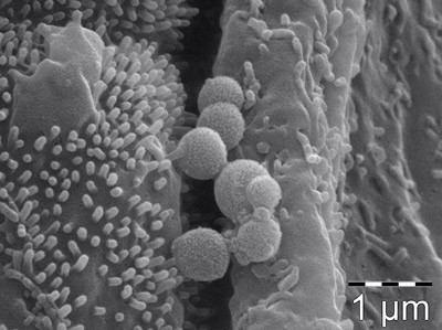 Figur 1  Elektronmikroskopisk bilde av sm&aring; kokker, trolig orale Veillonella, p&aring; lungeepitel hos en pasient med kronisk&hellip;