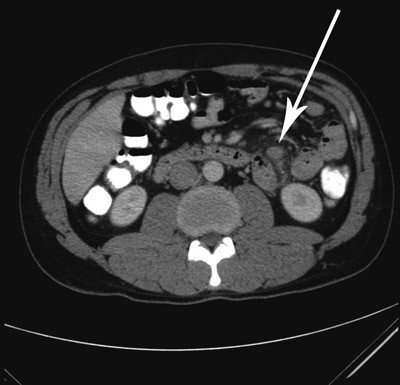 Figur 1  CT abdomen tatt med intraven&oslash;s kontrast viste reaktive forandringer med multiple forst&oslash;rrede lymfeknuter (pil) i&hellip;