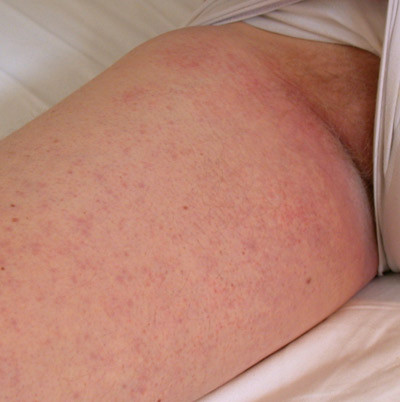 Figur 2  Utbredt makul&oslash;st konfluerende utslett i lyske