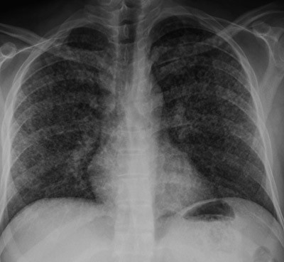 Figur 1  R&oslash;ntgen thorax ved innkomst i sykehuset viser disseminert utbredelse av sm&aring;nodul&aelig;re, stedvis dels konfluerende sm&aring;&hellip;