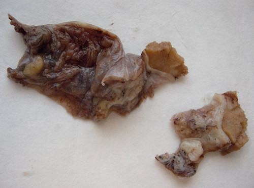 Figur 2  Operasjonsmaterialet fra epididymis og testis viser utbredt granulomat&oslash;s betennelse med nekroser og enkelte&hellip;