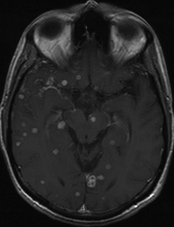 Figur 3  MR caput med aksiale T1-snitt etter omniskan intraven&oslash;st tatt fire uker etter innleggelsen viser kontrastopptak i&hellip;