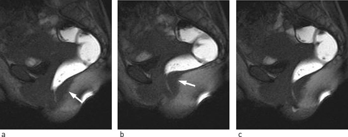 Figur 4  Overaktiv bekkenbunn-syndrom hos en 31 &aring;r gammel kvinnelig pasient, med f&oslash;lelse av inkomplett defekasjon. MR&hellip;
