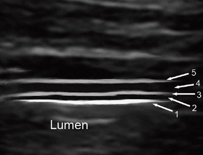 Figur 1  Et forst&oslash;rret og manipulert h&oslash;yfrekvent ultralydbilde som viser den karakteristiske femdelte lagdelingen i en&hellip;