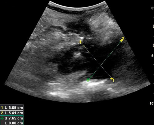 Figur 5  Pasient med Crohns sykdom. Bildet er tatt i h&oslash;yre regio iliaca (B-mode, 4 MHz). En hypoekkogen lesjon p&aring; 5,0 x 5,4&hellip;