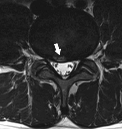 Figur 2  Transversalt T2-vektet bilde av skivebuking og annulusruptur (pil) i L4/L5-niv&aring;
