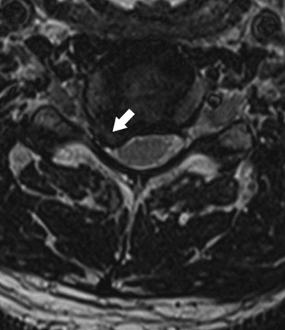 Figur 3  Transversalt T2-vektet bilde av cervikalt prolaps (pil) som gir innsnevring av h&oslash;yre sides rotkanal