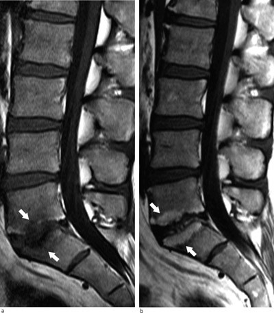 Figur 4  Sagittale T1-vektede bilder av degenerative beinmargsforandringer (Modic-forandringer). a) Type 1 med lavt T1&hellip;