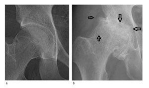 Figur 2  R&oslash;ntgenbilde av hofte. a) Normalt hofteledd. b) Hofteleddsartrose med p&aring;leiringer (pil mot h&oslash;yre), cyster (pil opp)&hellip;