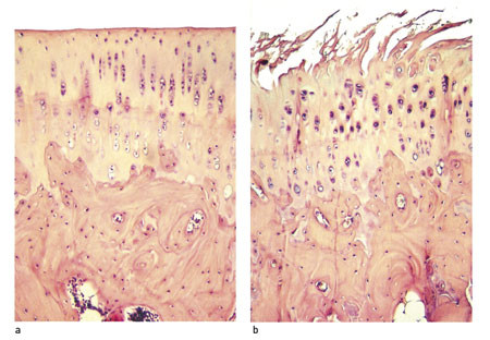 Figur 3  Leddbrusk og subkondralt bein. a) Normal kontrollbrusk. b) Veletablert artrose. Overflaten er oppfliket, og det er&hellip;
