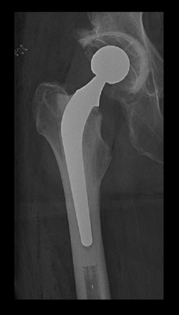 Figur 5  Sementert totalprotese i hofte