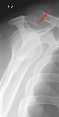 Figur 4  Skjelettr&oslash;ntgen med &laquo;outlet view&raquo; viser uttalte degenerative p&aring;leiringer (pil) som reduserer plassforholdene i det&hellip;