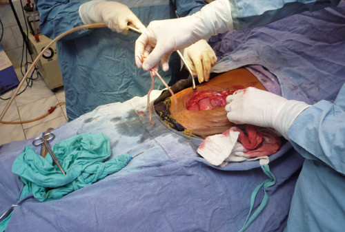 Figur 2  Avrevet tarm. Mange rundormer hadde r&oslash;mt ut i bukhulen. Vi brukte mye av operasjonstiden til &aring; lete etter&hellip;