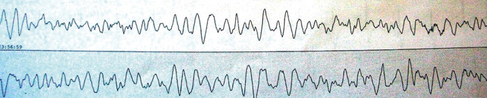 Figur 3  EKG-utskrift fra overv&aring;kningsskop med &oslash;kende og minkende amplitude som ved torsades de pointes