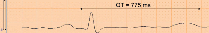 Figur 4  Betydelig forlenget QT-tid 0,775 s med korrigert verdi QTc 0,685 s (< 460 ms). Pasienten hadde tidligere normal QT&hellip;