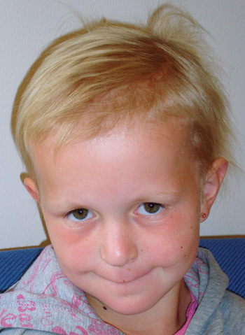 Figur 1  Pasient 1 har kort, tynt, lyst h&aring;r, sparsomme &oslash;yebryn, lett bulb&oslash;s nesetipp med sm&aring; nesevinger og glatt, noe langt&hellip;