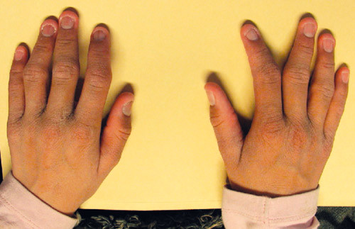 Figur 2a  Pasient 4 har korte fingre, skjevstilling i flere proksimale interfalangeale (PIP) ledd, s&aelig;rlig p&aring; 2. finger,&hellip;