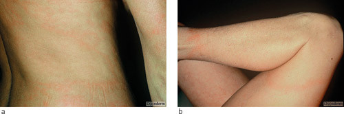 Figur 1 a, b)  Eksempler p&aring; erythema migrans. Gjengitt med tillatelse fra www.danderm.dk