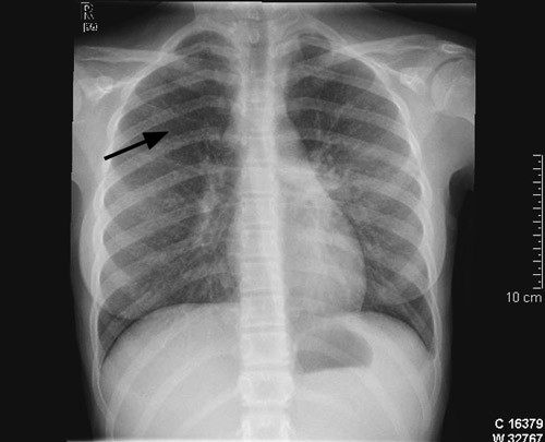 Figur 1  R&oslash;ntgen av thorax tatt f&oslash;r behandlingsstart viser sparsomme retikulonodul&aelig;re fortettingar i b&aring;e lunger (pil)