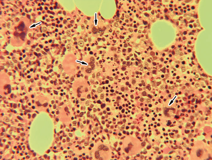 Figur 1  Hematoksylin-eosin-farging av beinmargsbiopsi. Det ses triline&aelig;r hyperplasi og &oslash;kt antall dysplastiske&hellip;