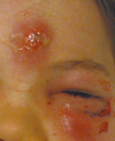 Figur 1  Pasientens lesjoner tidlig under sykehusoppholdet f&oslash;r mikrobiologisk diagnose og f&oslash;r m&aring;lrettet behandling