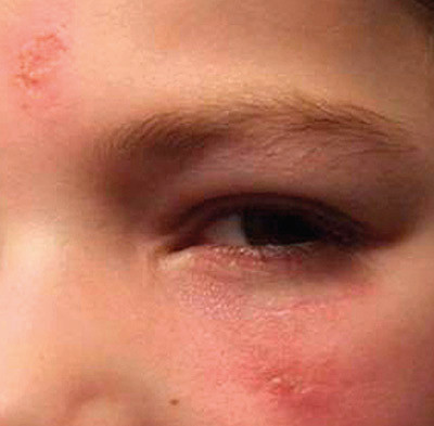 Figur 4  Pasientens lesjoner etter omtrent fem uker med m&aring;lrettet antibiotikabehandling