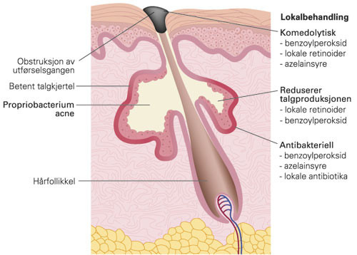 Figur 1  Talgkjertelens anatomi og angrepspunkter for ulike legemidler for lokalbehandling