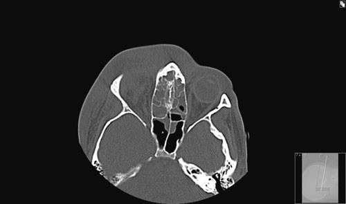 Figur 1  CT uten kontrast viser betydelige fortetninger i alle sinuser, bl&oslash;tdelshevelse/cellulitt i h&oslash;yre orbitaregion og&hellip;