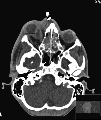 Figur 3  Intraorbital abscess mellom musculus rectus medialis og nervus opticus
