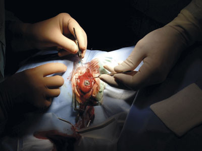 Figur 4  L&oslash;sning av conjunctiva for evakuering av retrobulb&aelig;r abscess