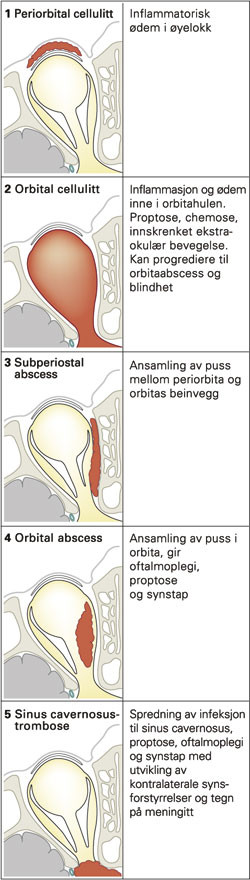 Figur 6  Chandlers klassifikasjon av orbitakomplikasjoner