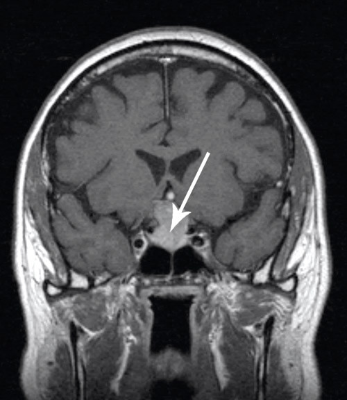 Figur 2  MR-unders&oslash;kelse av hypofysen viser et makroadenom (pil) som vokser gjennom sella turcica opp til chiasma opticum og&hellip;