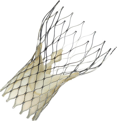 Figur 2  Medtronic Corevalve selvekspanderende aortaklaffprotese, ekspandert. Gjengitt med tillatelse fra produsenten
