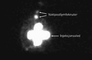 Figur 1  Lymfoscintigram av h&oslash;yre bryst og aksille. Sentralt vises kraftig radioaktivitet ved injeksjonsstedet periareol&aelig;rt&hellip;