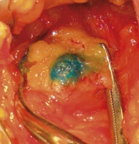 Figur 2  Vaktpostlymfeknute i aksillen med godt opptak av fargestoffet patentbl&aring;tt V