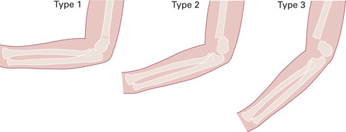 Figur 1  Gartlands klassifikasjon av suprakondyl&aelig;re humerusfrakturer hos barn. Klassifikasjonen er basert p&aring; grad av&hellip;