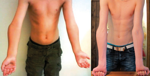 Figur 2  Cubitus varus hos en gutt etter en h&oslash;yresidig suprakondyl&aelig;r humerusfraktur. Til venstre seks &aring;r etter skaden, til&hellip;