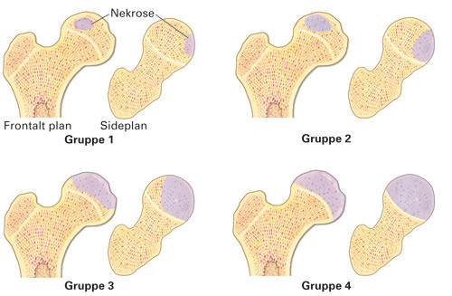Figur 2  Catteralls klassifikasjon av caputnekrosens utbredelse ved Calv&eacute;-Legg-Perthes&rsquo; sykdom &ndash; gruppe 1 : < 25 %&hellip;