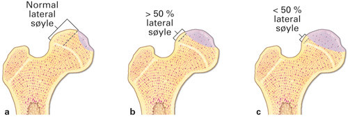 Figur 3  Laterals&oslash;yleklassifikasjon av caputaffeksjon ved Calv&eacute;-Legg-Perthes&rsquo; sykdom. a) Laterale s&oslash;yle normal; b) laterale&hellip;