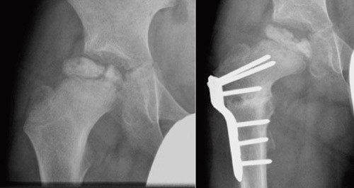Figur 4  R&oslash;ntgenbilde som viser redusert caputdekning hos ni &aring;r gammel gutt med Calv&eacute;-Legg-Perthes&rsquo; sykdom (venstre bilde)&hellip;