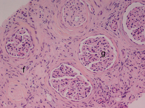 Figur 1  Lysmikroskopisk bilde av nyrebiopsi, med uttalt interstitiell fibrose (f) mellom glomeruli (g)