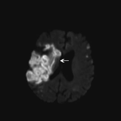 Figur 2  Diffusjonsvektet MR tre m&aring;neder etter f&oslash;rste innleggelse viser et nytt ferskt hjerneinfarkt (pil) i h&oslash;yre arteria&hellip;