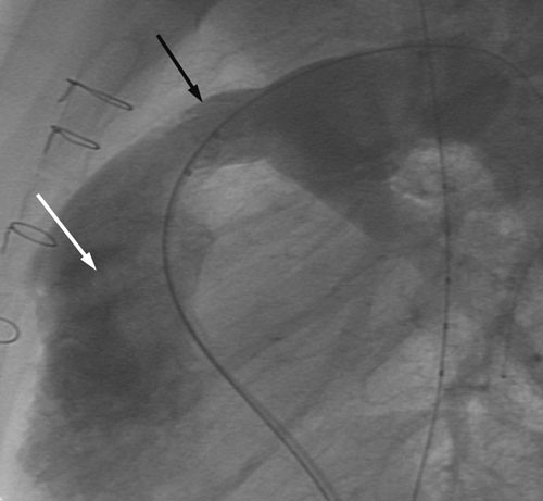 Figur 1  Angiografisk bilde fra siden med kontrastinjeksjon i pulmonalarteriens hovedstamme. Bildet viser tranghet i&hellip;