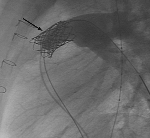 Figur 2  Gjentatt angiografisk bilde (samme pasient som i figur 1) med kontrastinjeksjon i pulmonalarteriens hovedstamme&hellip;