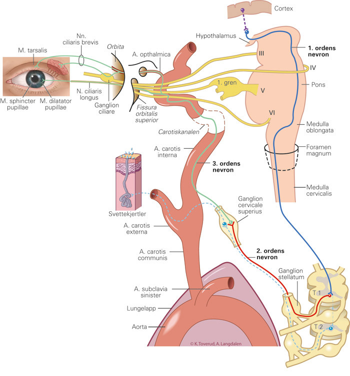Figur 1  Den okulosympatiske banen - anatomi og klinisk presentasjon. Skade eller dysfunksjon i de langstrakte sympatiske&hellip;