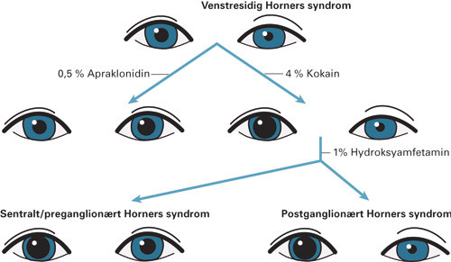 Figur 2  Farmakologisk testing ved bruk av &oslash;yedr&aring;per kan benyttes i topografisk diagnostikk av Horners syndrom