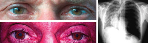 Pasient 3  Preganglion&aelig;r lesjon (spontan trykkpneumothorax). En lang og tynn mann i 30-&aring;rene fikk akutt smerte i venstre&hellip;