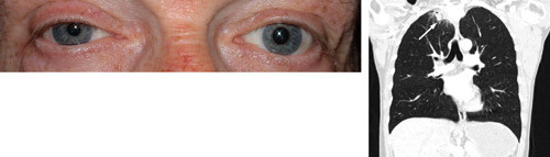 Pasient 4  Pancoasts tumor. En tidligere frisk 50 &aring;r gammel r&oslash;yker hadde en m&aring;ned tidligere merket at h&oslash;yre &oslash;yelokk hang ned&hellip;